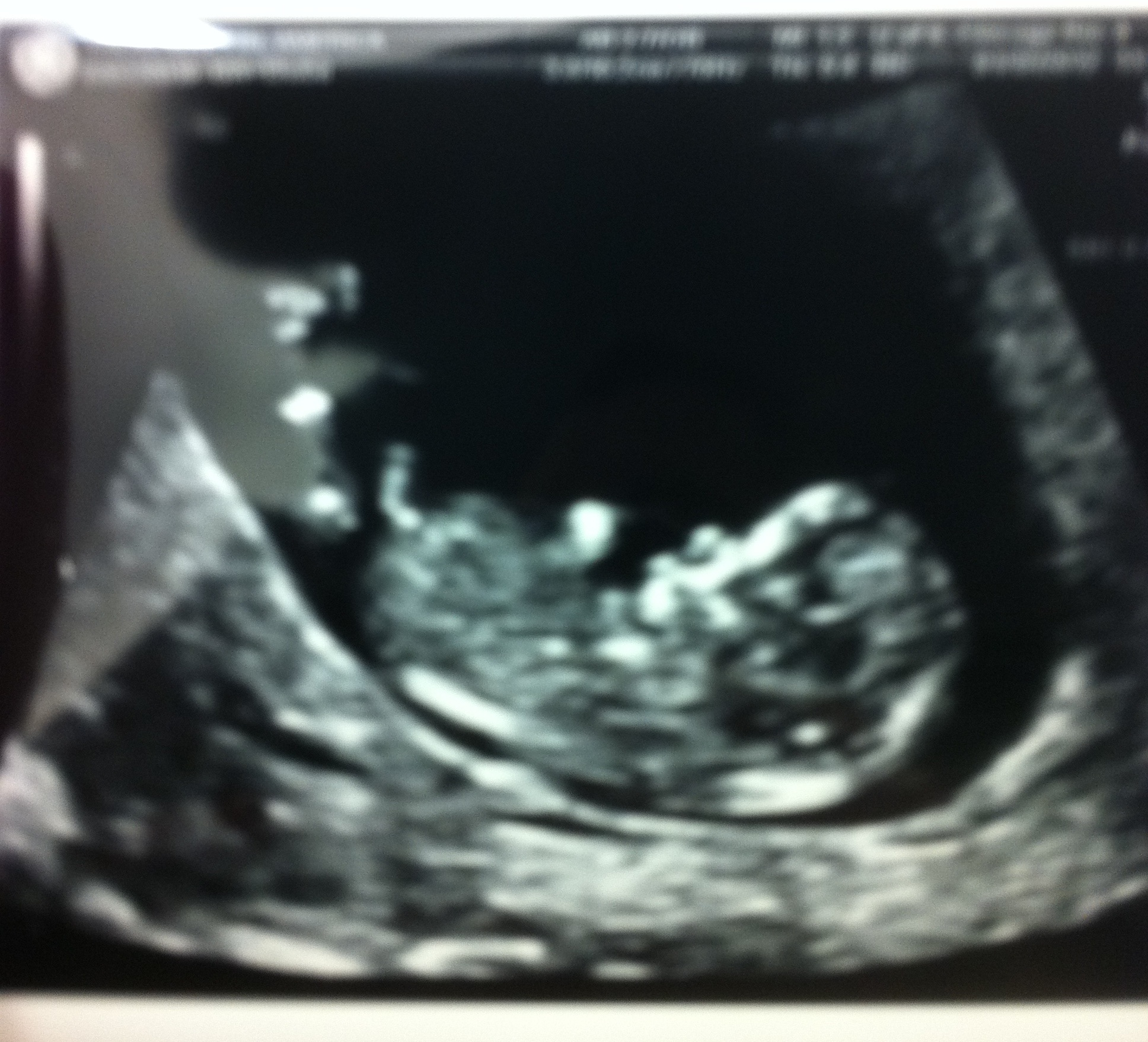 A developing fetus is visible inside the womb in a prenatal ultrasound scan.