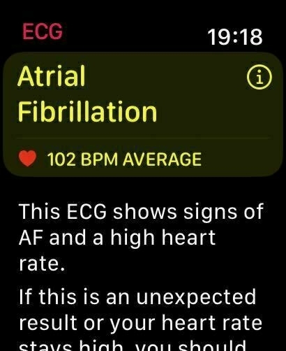 Apple Watch Artial Fibrillation