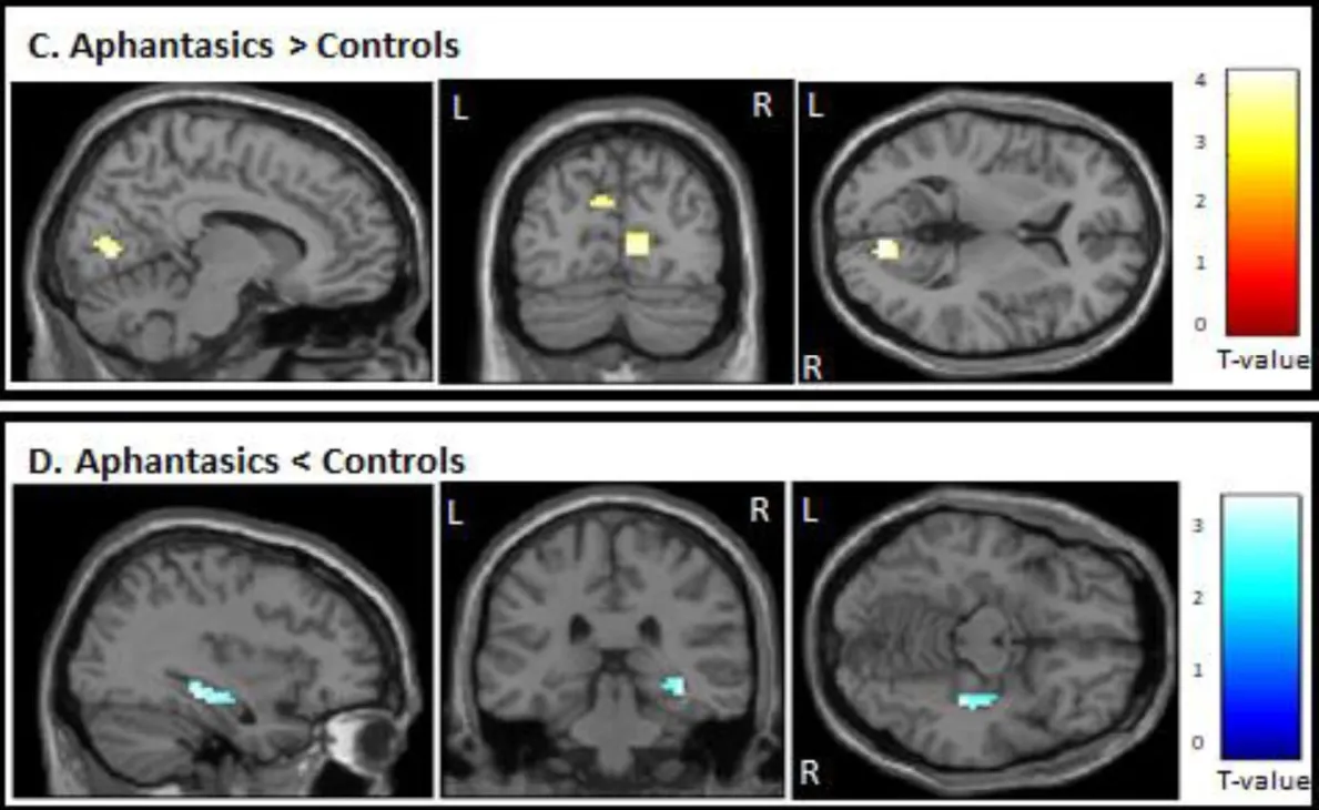 Auto-generated description: Three brain scan images display highlighted areas with contrasting activity levels, indicated by color gradients, across two different conditions labeled Aphantasics > Controls.