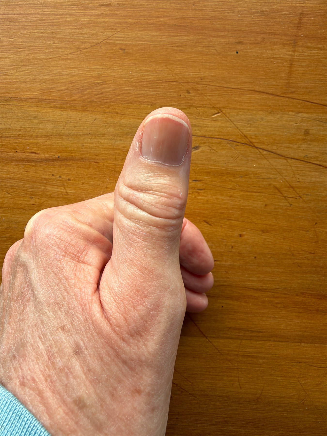 My left thumb has a swollen joint and looks a bit bent.