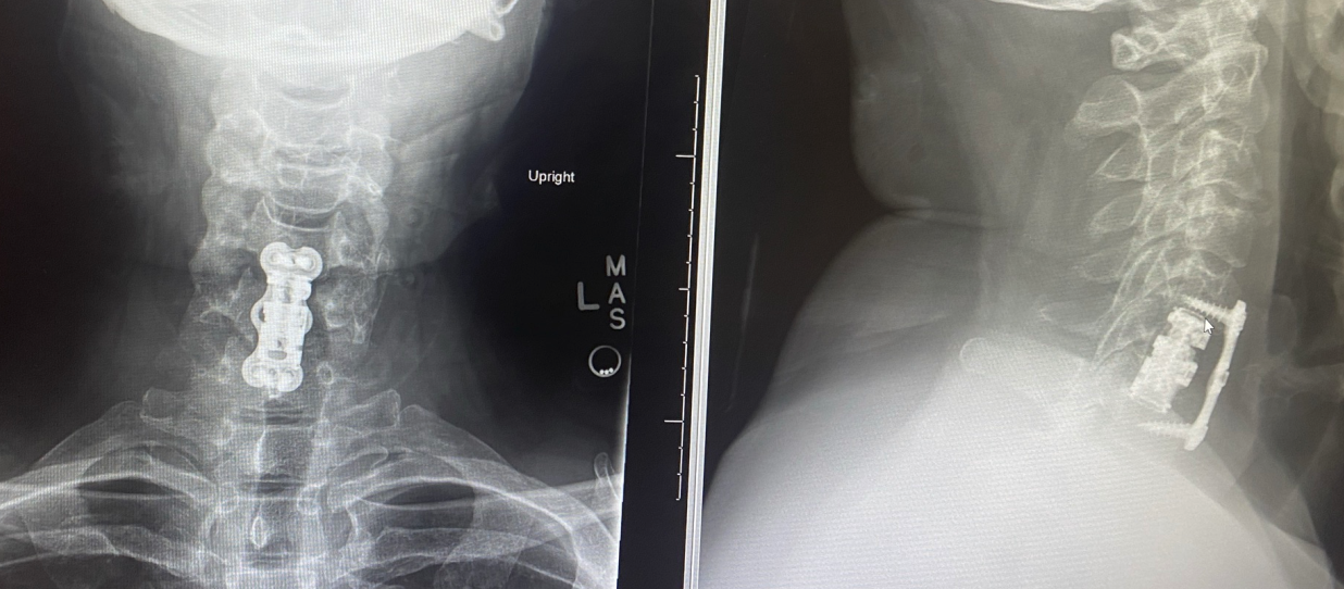 Hardware in spine