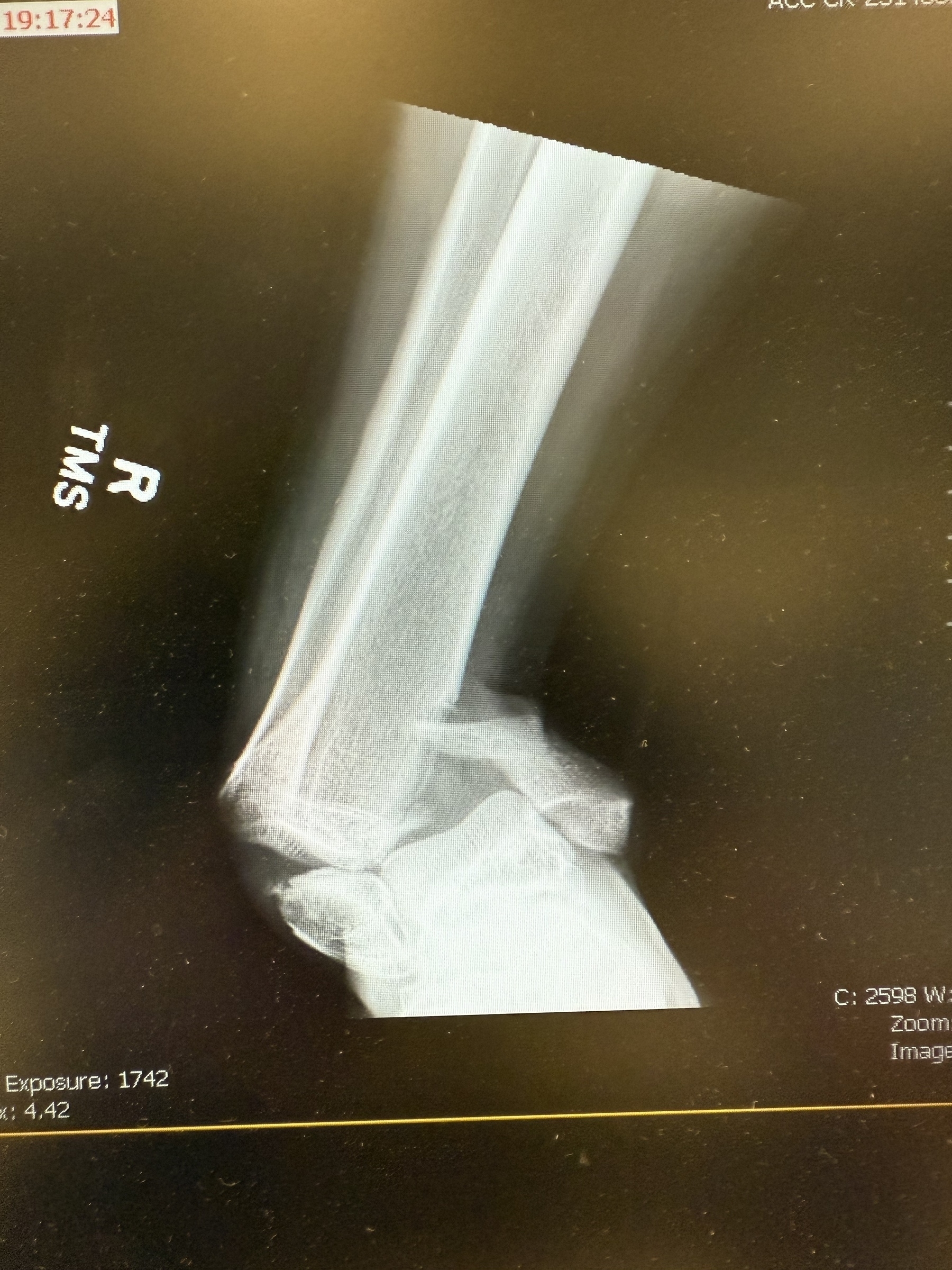 right-sided trimalleolar ankle fracture / dislocation shown as a single view X-ray