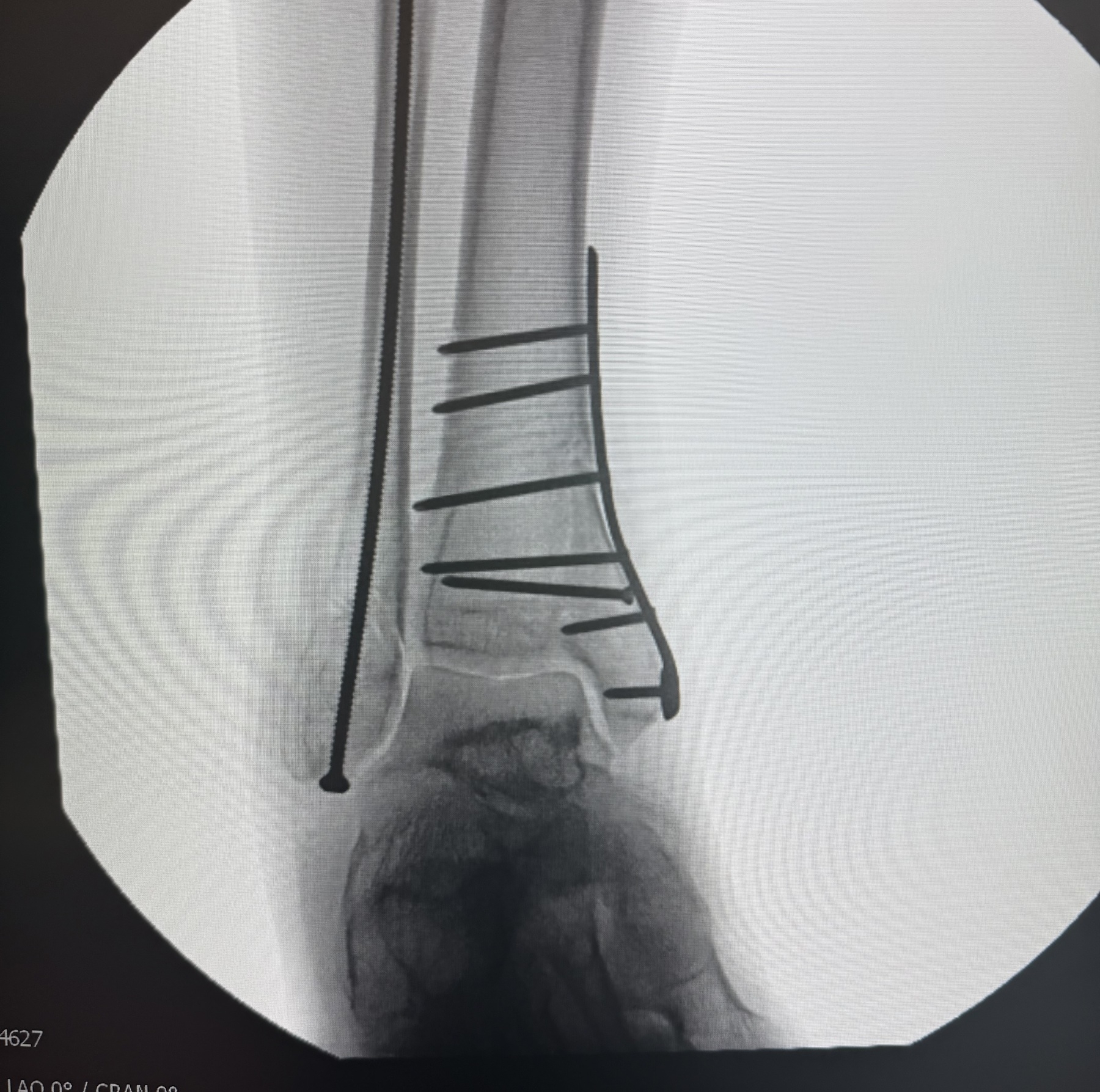 intraoperative right ankle X-ray with metal plate, rod, screws in place to hold entire joint and lower leg in alignment and allow healing