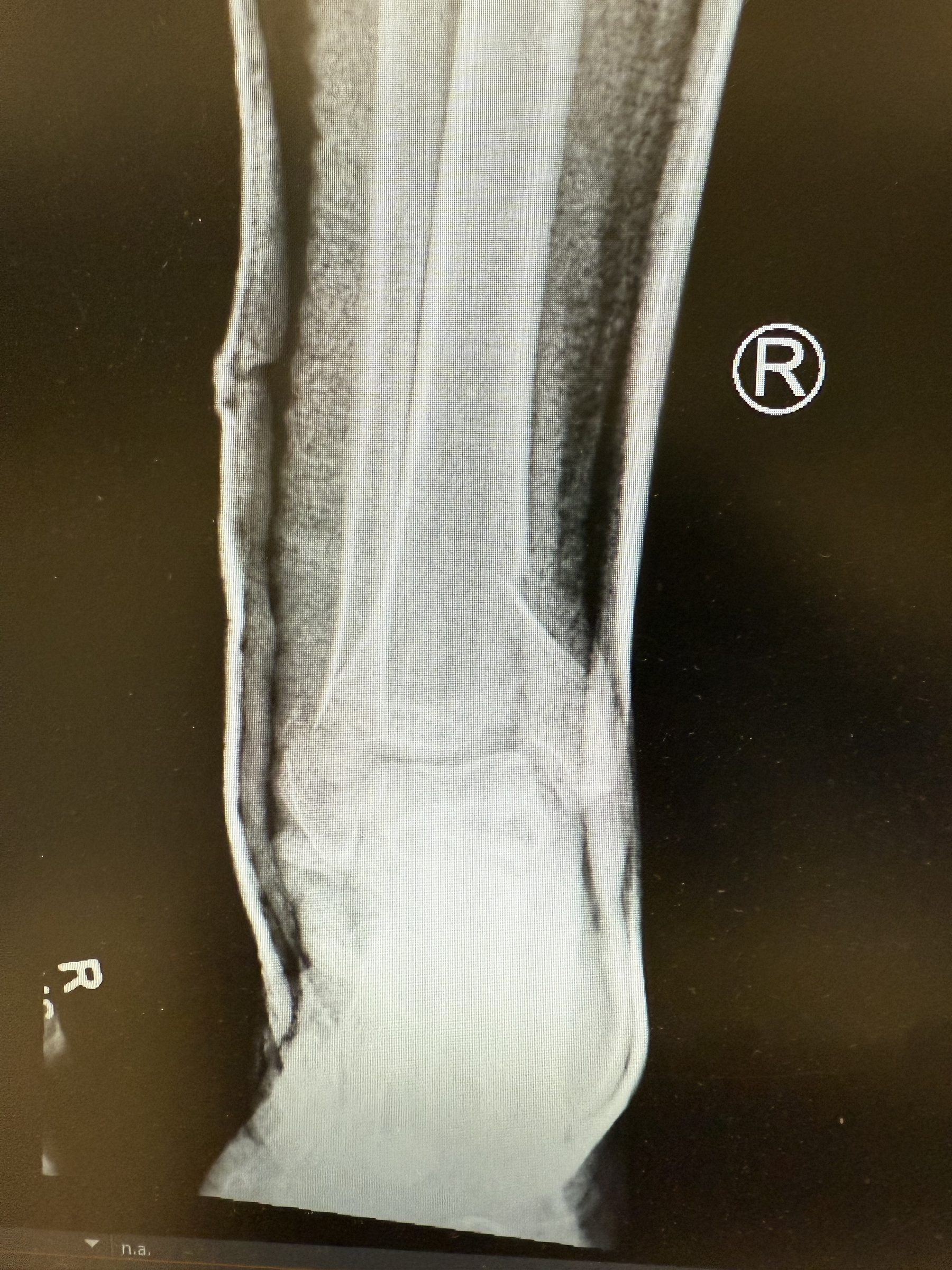 post-reduction of dislocation and setting of fracture with placement of well-molded splint on portable right-sided ankle radiograph