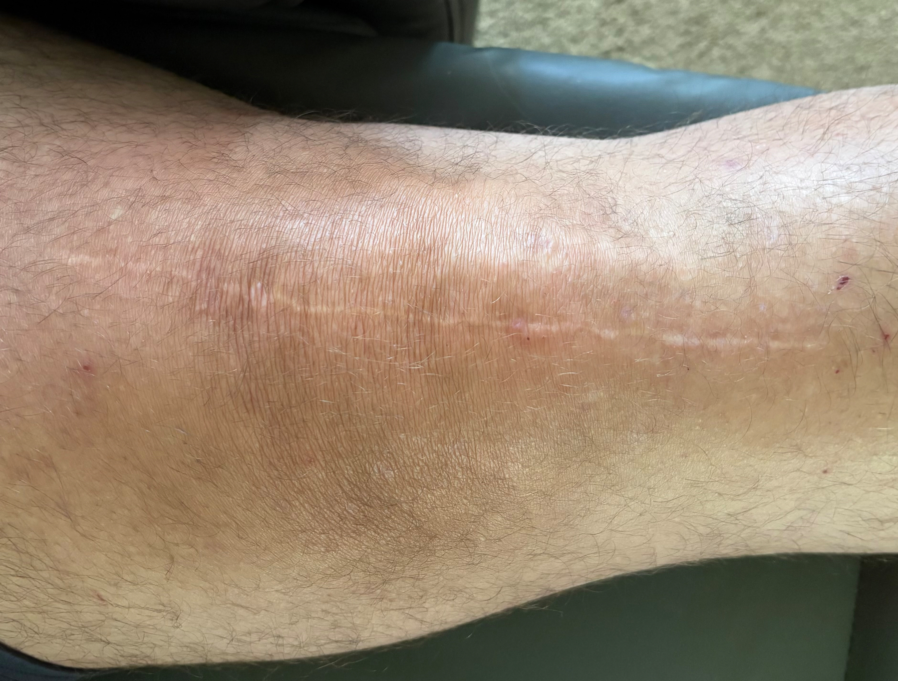 Picture of my left knee with a long vertical scar.